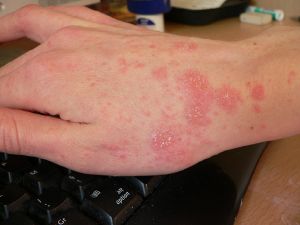 Scabies - New World Encyclopedia