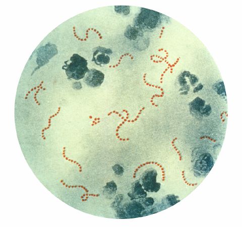 Scarlet fever - New World Encyclopedia